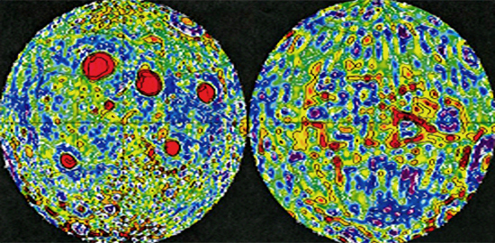 Gravity anomalies on the Moon